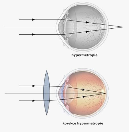 Hypermetropie (dalekozrakost)